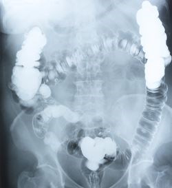 Image of an xray of the intestines